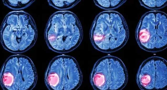 Resultado de imagen para tumores cerebrales